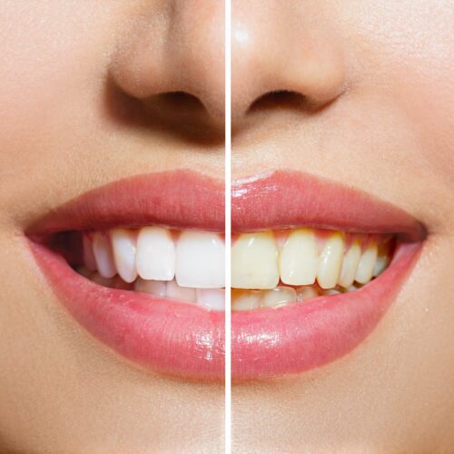 Wybielanie zębów - Gabinet stomatologiczny | Gowarzewo, Zalasewo